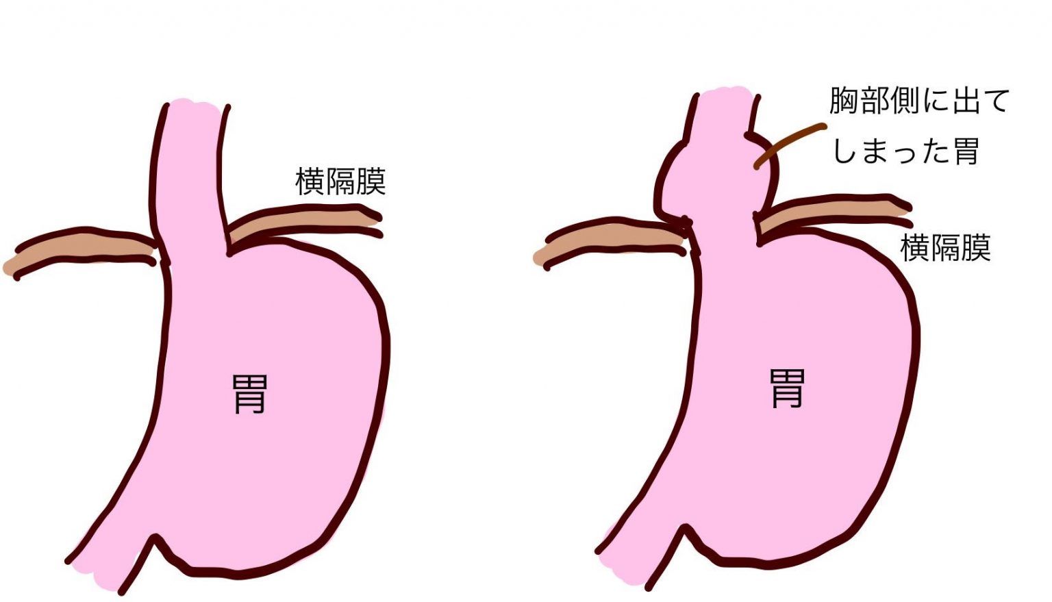 食道裂孔ヘルニアの症状のある男性