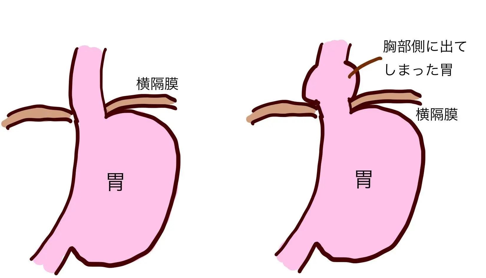 滑脱 型 食道 裂孔 ヘルニア