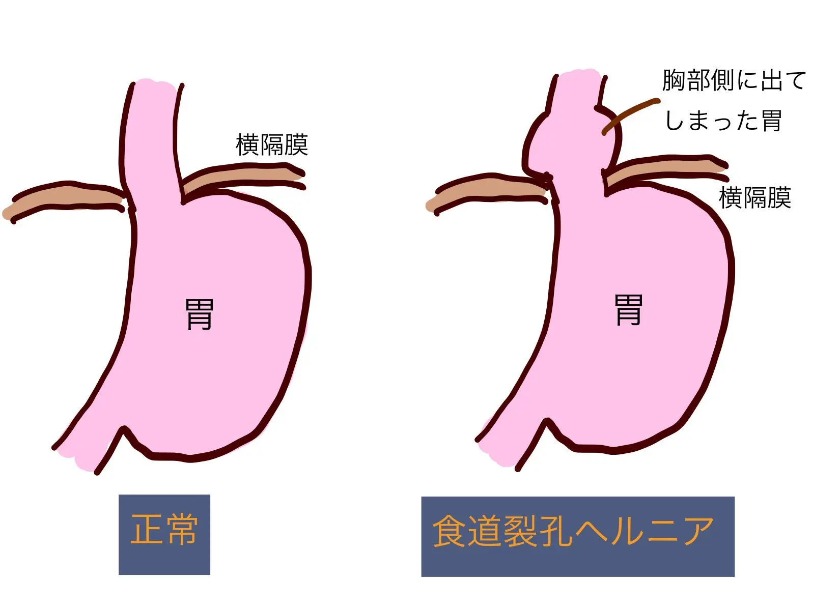 食道裂孔ヘルニアになりやすい人とは 症状 検査 治療も解説