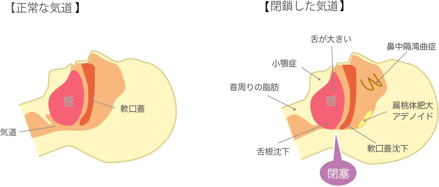 睡眠時無呼吸症候群(SAS)について|京都市中京区の今井内科胃腸 睡眠時無呼吸症候群(SAS)について|京都市中京区の今井内科胃腸